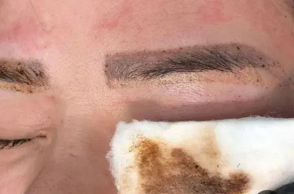 پاک کردن تتو تضمینی|خدمات آرایشگری و زیبایی|دهدشت, |دیوار