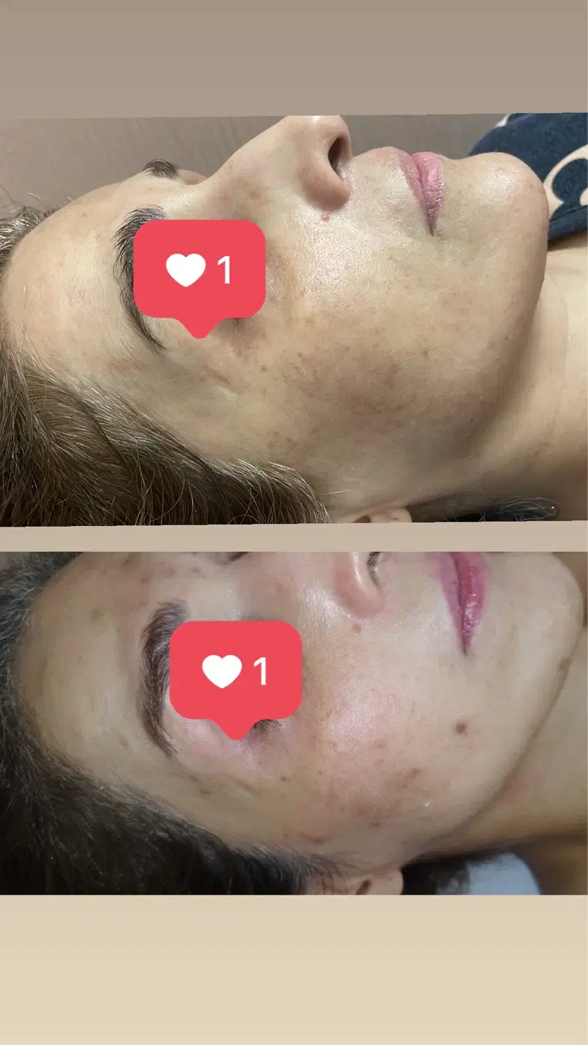 درمان قطعی لک و جوش در کوتاهترین زمان|خدمات آرایشگری و زیبایی|مشهد, چهارچشمه|دیوار