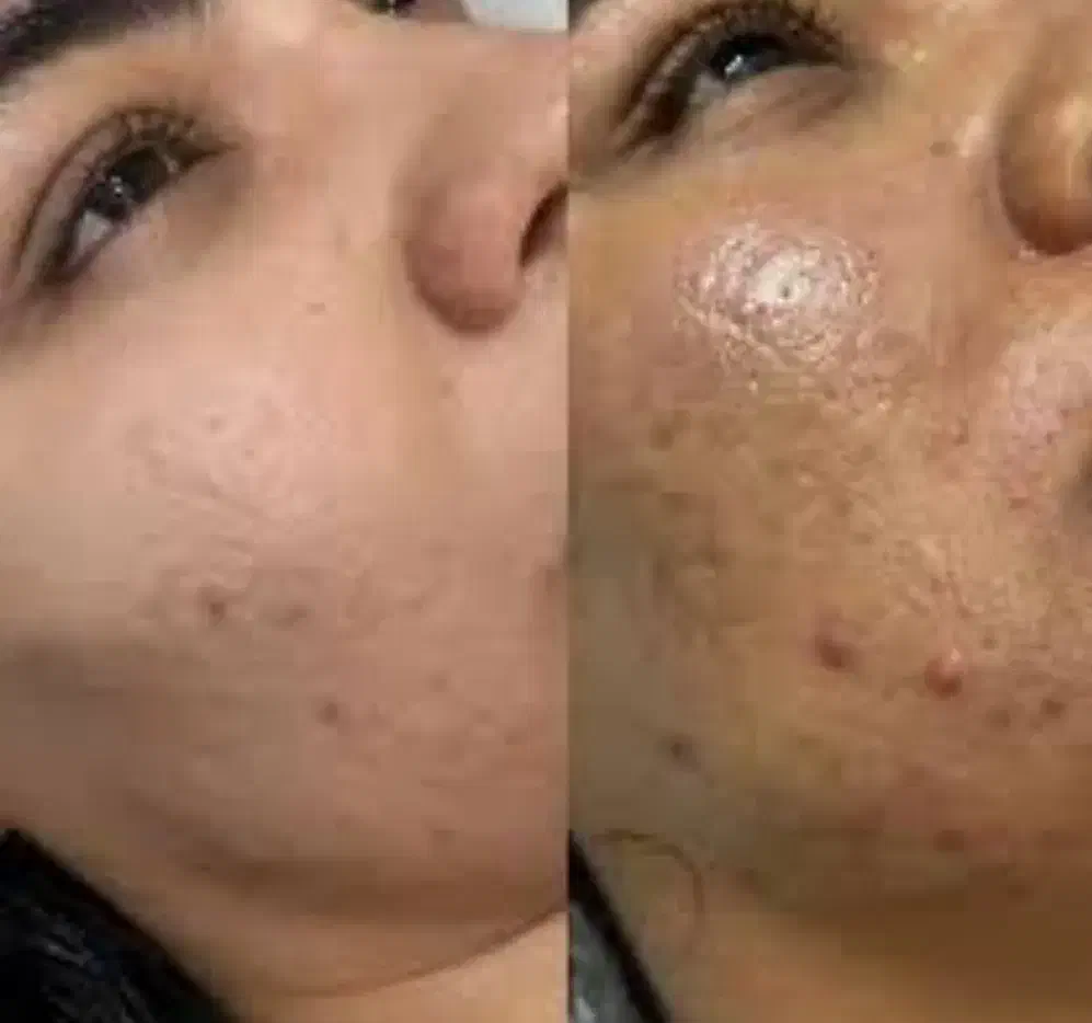 پاکسازی صورت درماپلینگ بابهترین مواد|خدمات آرایشگری و زیبایی|بیرجند, |دیوار