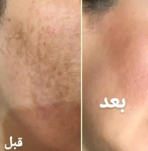 روشن کننده قوی|آرایشی، بهداشتی، درمانی|خوسف, |دیوار