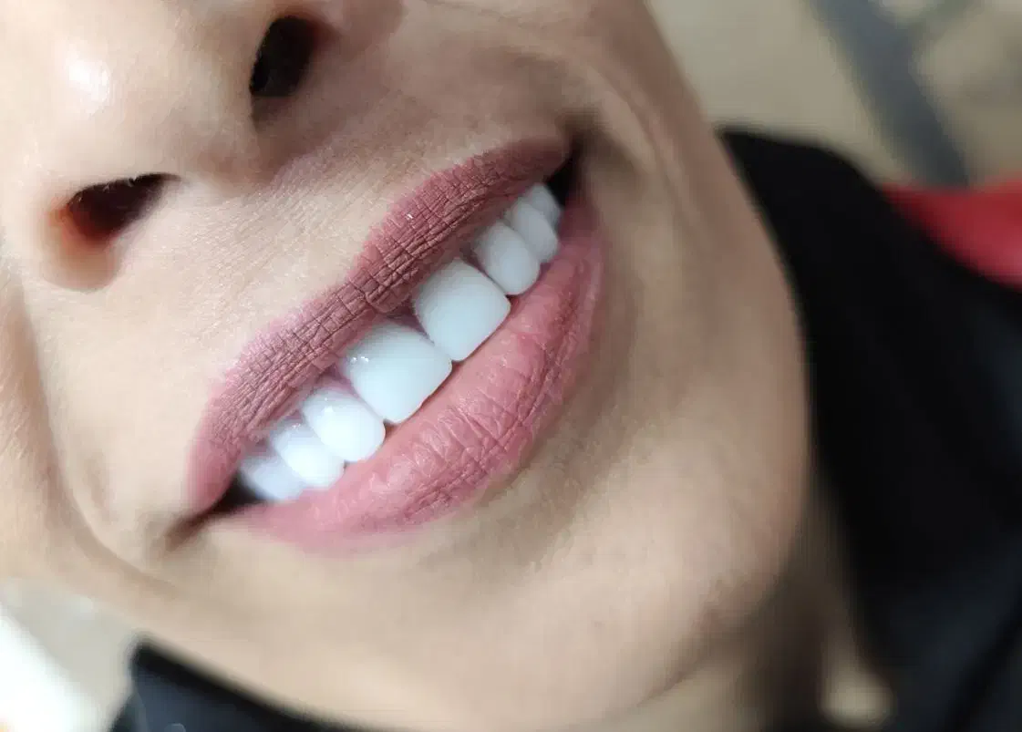 دندان مصنوعی طرح کامپوزیت و لمینت هر فک ۵ تومان|خدمات آرایشگری و زیبایی|کرج, کمالشهر|دیوار