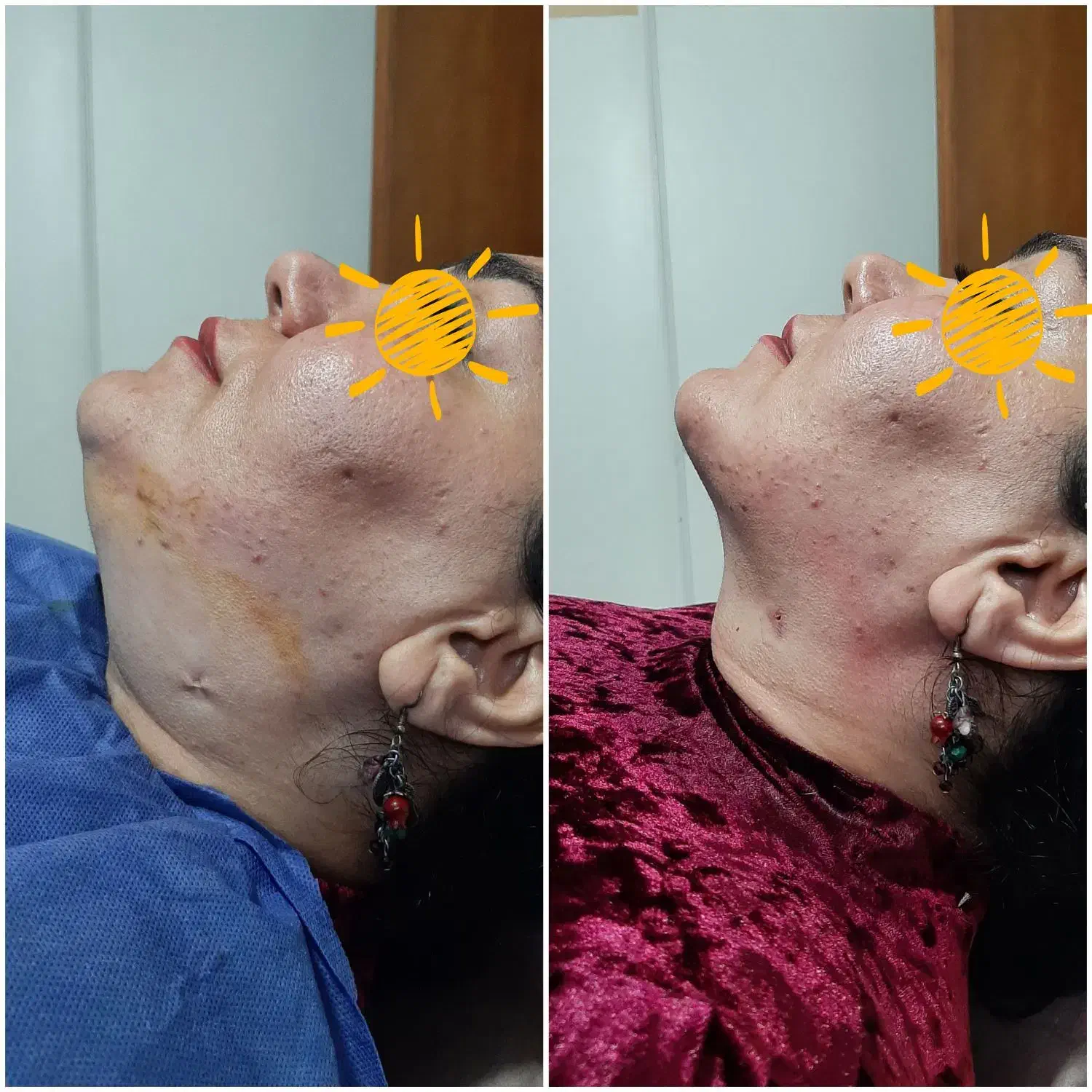 تزریق چربی برای مدت محدود|خدمات آرایشگری و زیبایی|تهران, ایرانشهر|دیوار