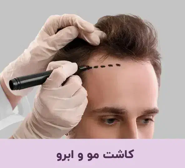 خدمات کاشت مو و ابرو|خدمات آرایشگری و زیبایی|پارسآباد, |دیوار