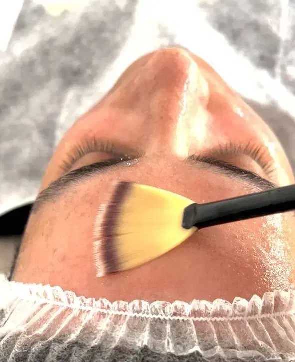 مدل برای اسیدتراپی|خدمات آرایشگری و زیبایی|رشت, پورسینا|دیوار