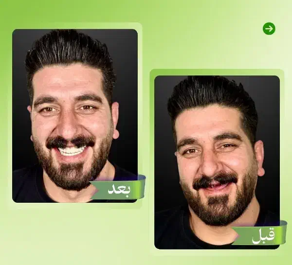 جشنواره ایمپلنت تاشب یلدافقط/۷۹۰۰|خدمات آرایشگری و زیبایی|نیریز, |دیوار