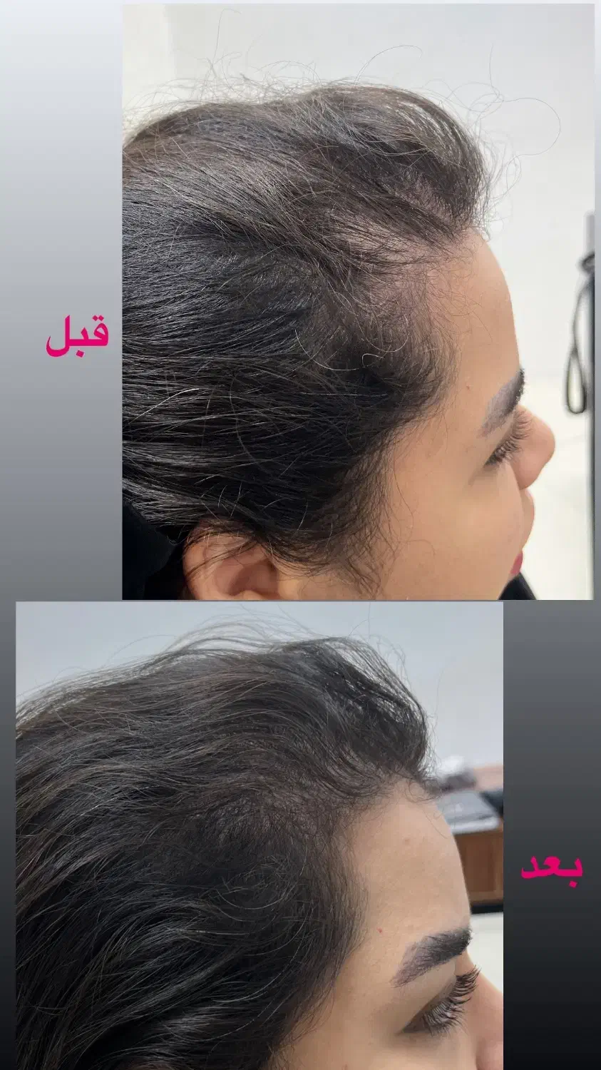 پاکسازی سر،موخوره گیری،اسکالپ،درمان ریزش،رویش مجدد|خدمات آرایشگری و زیبایی|قم, هفت تیر|دیوار