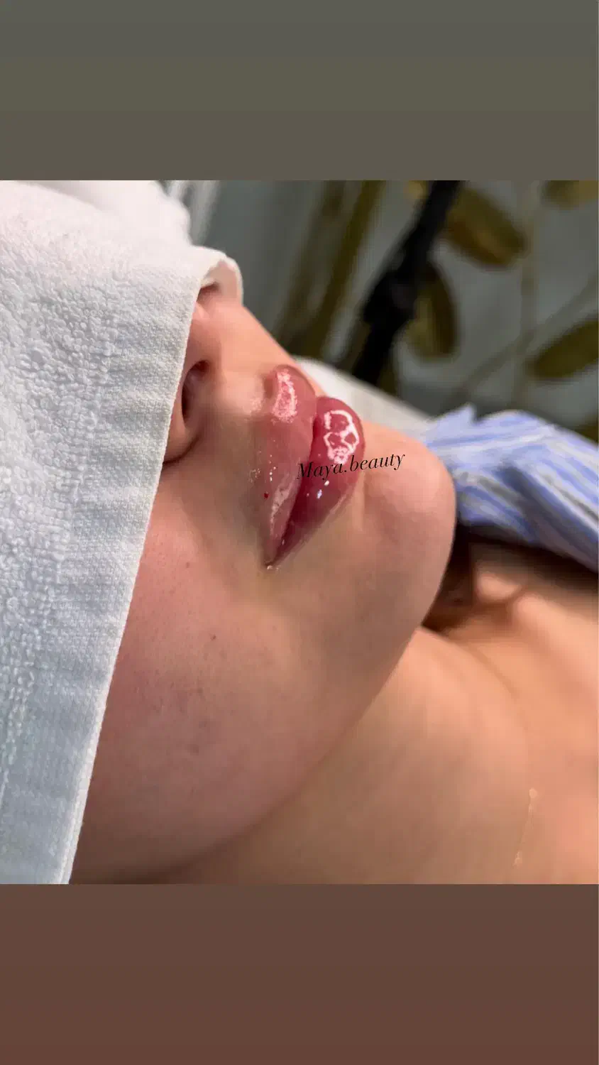 تزریق ژل فیلر بوتاکس تخفیف پاییزی|خدمات آرایشگری و زیبایی|اصفهان, مرداویج|دیوار