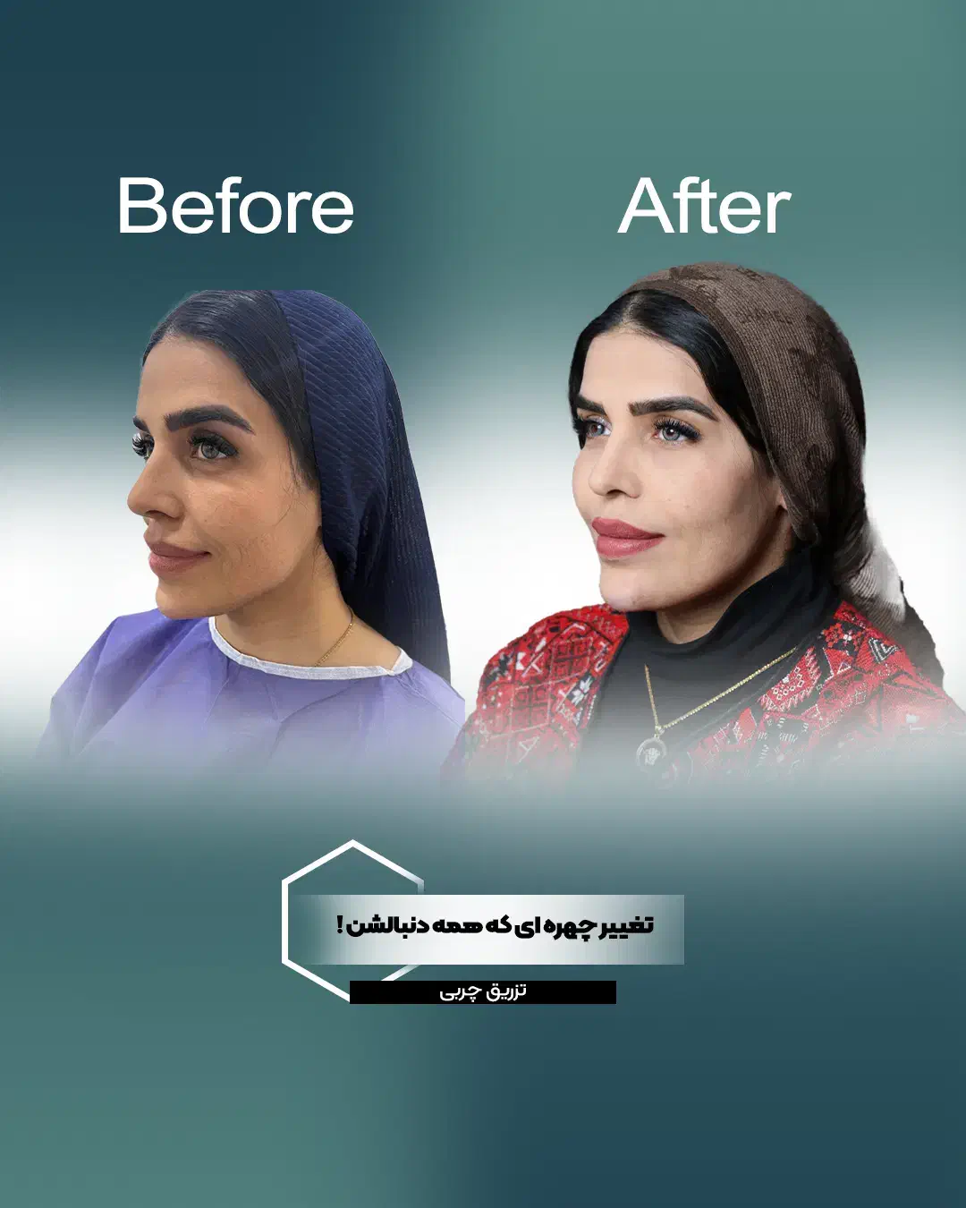 بلفارو/ لیفت صورت و ابرو/غبغب/تزریق چربی با تخفیف|خدمات آرایشگری و زیبایی|مشهد, سجاد شهر|دیوار