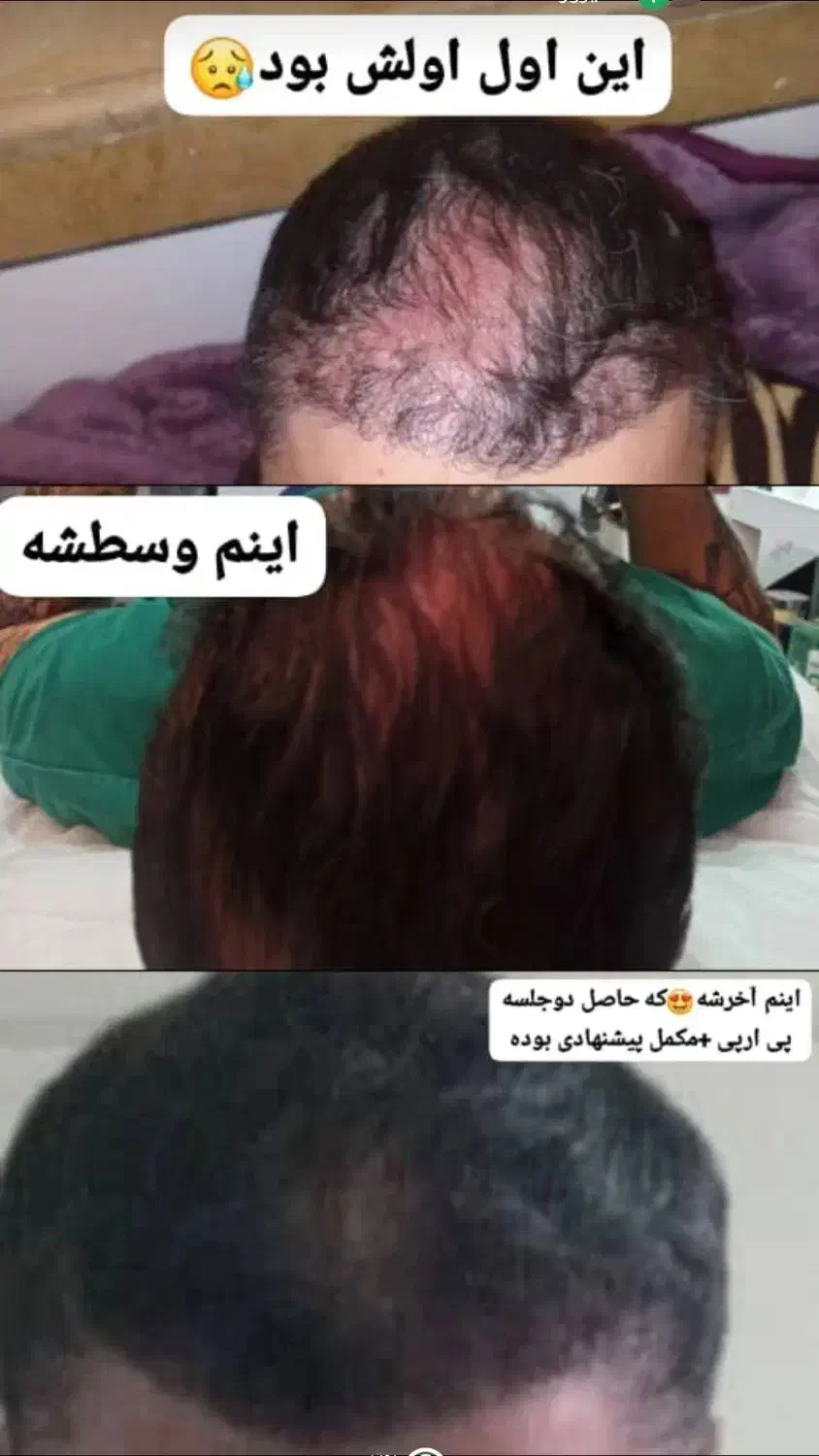 پی ارپی صورت ومو ومزوتراپی صورت ومو تخفیف ویژه|خدمات آرایشگری و زیبایی|کازرون, |دیوار