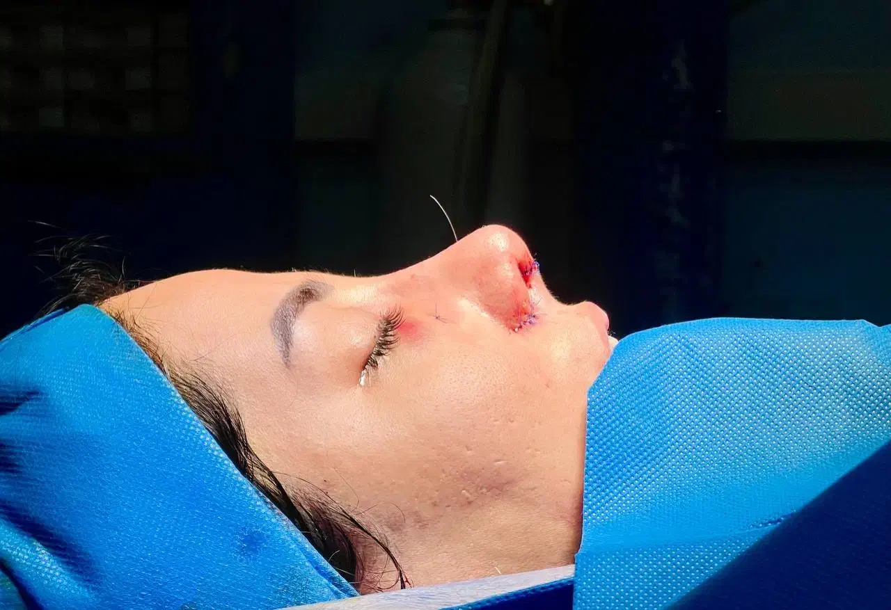 جراحی زیبایی بینی توسط جراح متخصص گوش و‌حلق و بینی|خدمات آرایشگری و زیبایی|قوچان, |دیوار