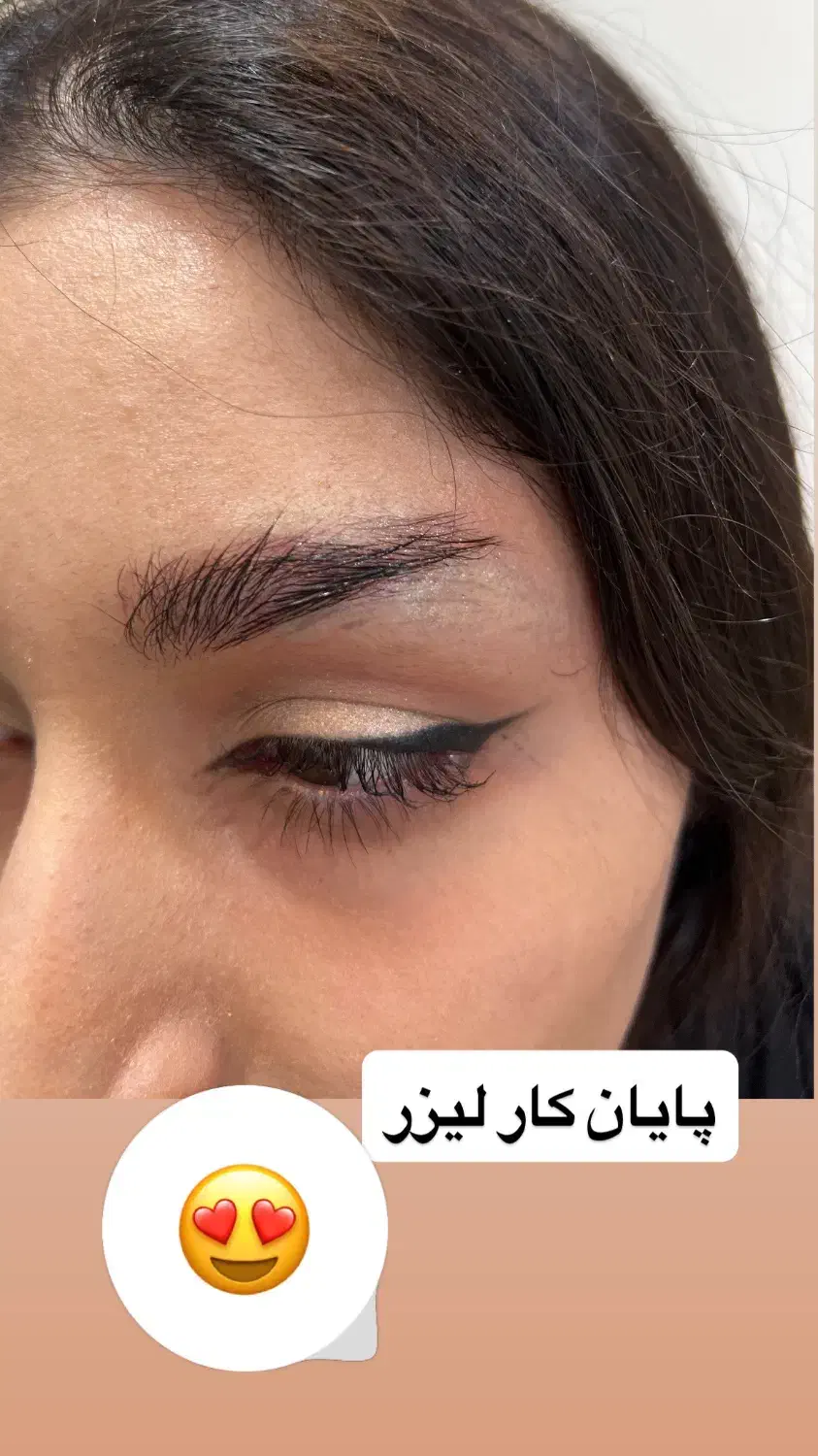 پاک کردن تتو با لیزر با قیمت فوق العاده|خدمات آرایشگری و زیبایی|کرمانشاه, |دیوار