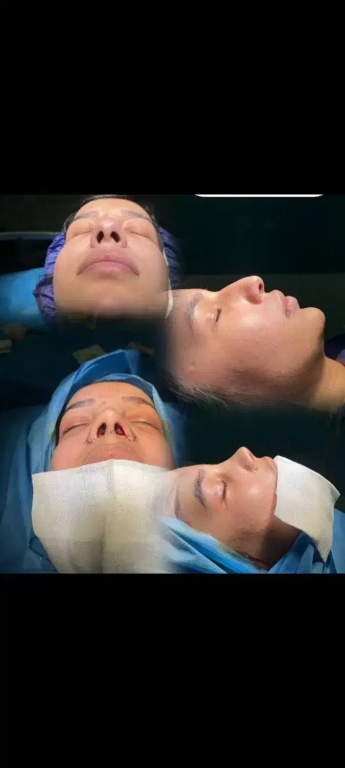 جراحی زیبایی بینی|خدمات آرایشگری و زیبایی|قائم‌شهر, |دیوار