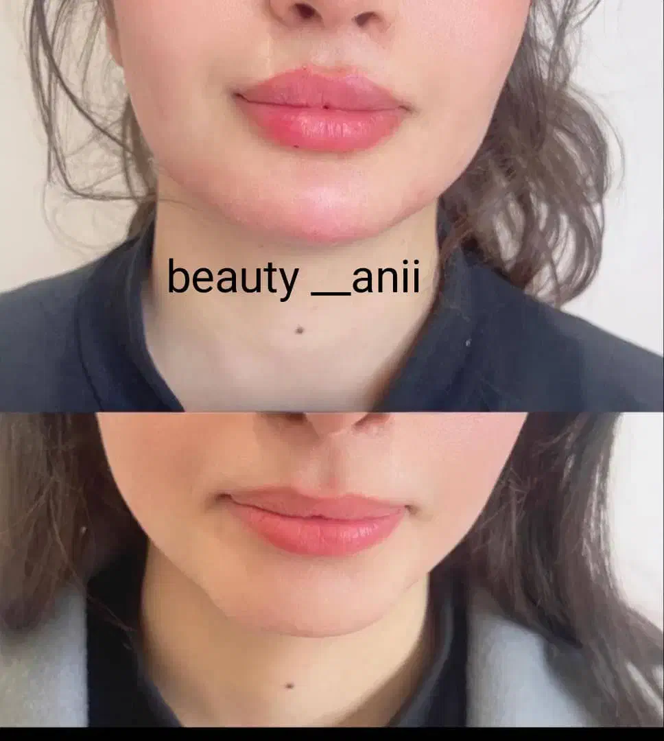 جشنواره ژل لب روسی و بوتاکس|خدمات آرایشگری و زیبایی|فردیس, شهرک ارم|دیوار