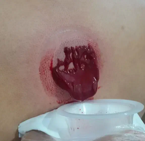 زالو فصد حجامت طب سوزنی طب سنتی بادکش گرم و سرد|خدمات آرایشگری و زیبایی|اصفهان, طامه|دیوار