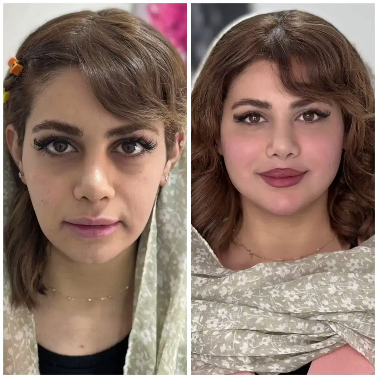 ژل وبوتاکس ،هایفو،پاک کردن تتو،چربی دکتر جابری فر|خدمات زیبایی و سلامت|کرمانشاه, |دیوار