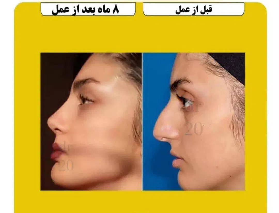 جراحی زیبایی بینی با قیمت باورنکردنی|خدمات آرایشگری و زیبایی|شیراز, ستارخان|دیوار