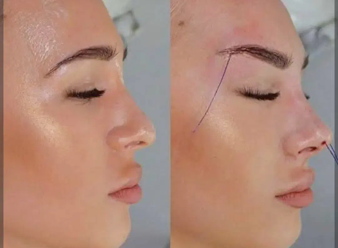 تزریق چربی .فیلر.نخ.ژل|خدمات آرایشگری و زیبایی|جهرم, |دیوار