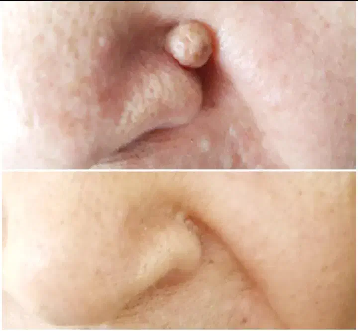 خال برداری ،میخچه زگیل وتمامی زائده هاباقطره گیاهی|خدمات آرایشگری و زیبایی|اصفهان, شفق|دیوار