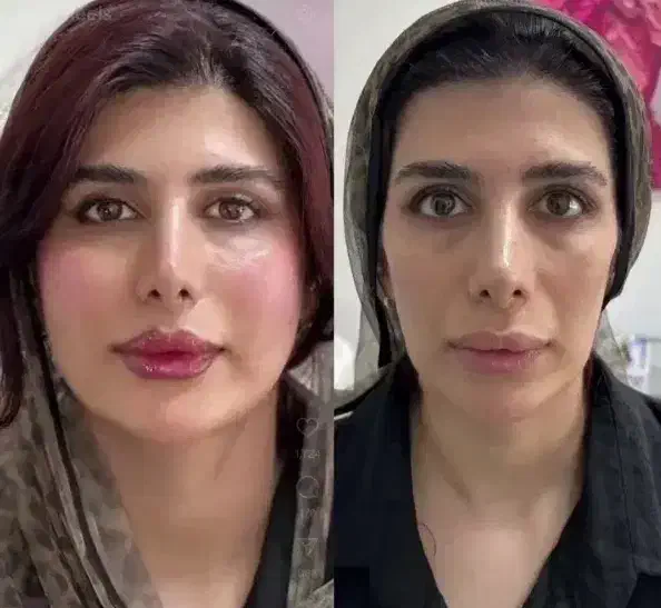 ژل و بوتاکس کاشت ابرو قسطی|خدمات آرایشگری و زیبایی|یاسوج, |دیوار