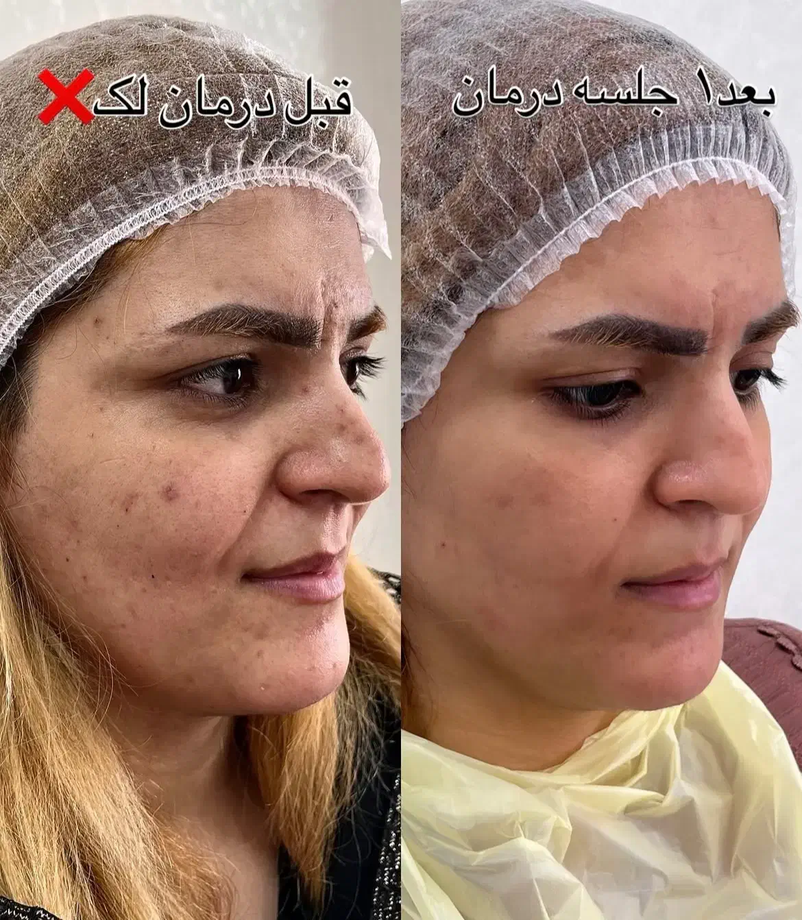 ریموتتوروشن کردن نواحی تیره درمان لک|خدمات آرایشگری و زیبایی|قم, باجک دو|دیوار