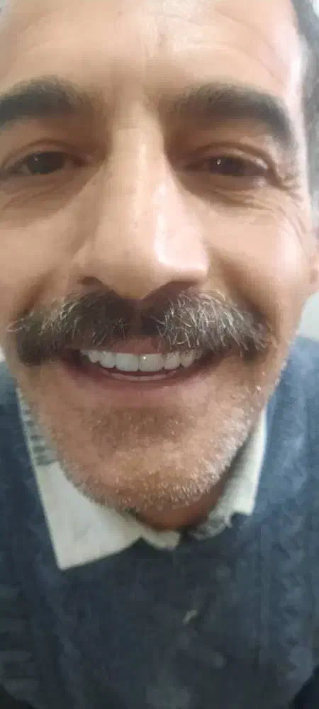 دندان مصنوعی در محل شما با کیفیت تضمینی|خدمات آرایشگری و زیبایی|هشتگرد, شهرک ریحانه|دیوار