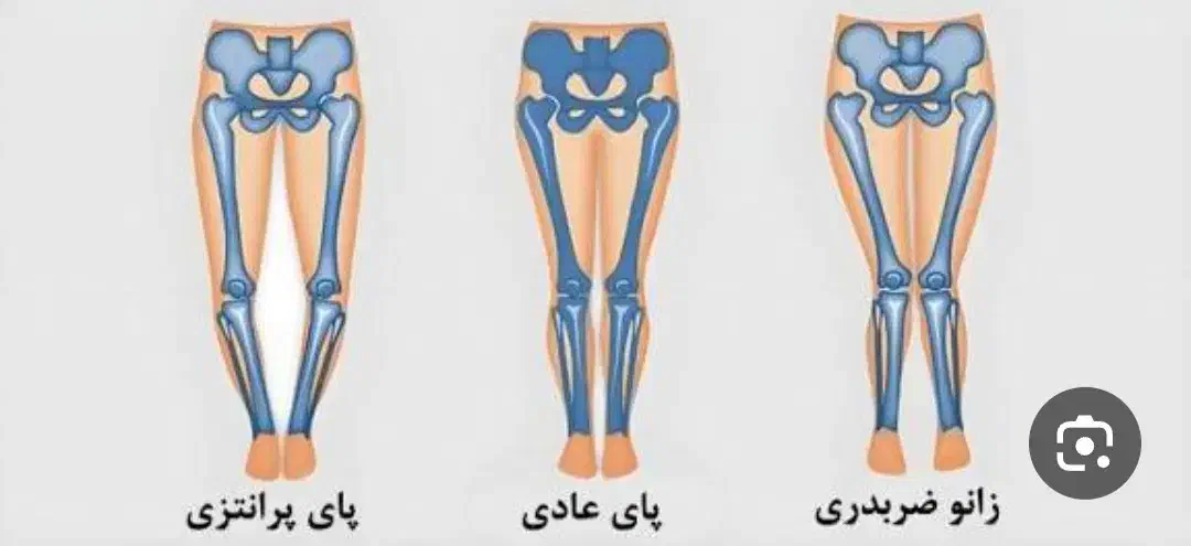 کلینیک تخصصی بهبود غیرجراحی انحرافات زانو|خدمات آرایشگری و زیبایی|بهار, |دیوار