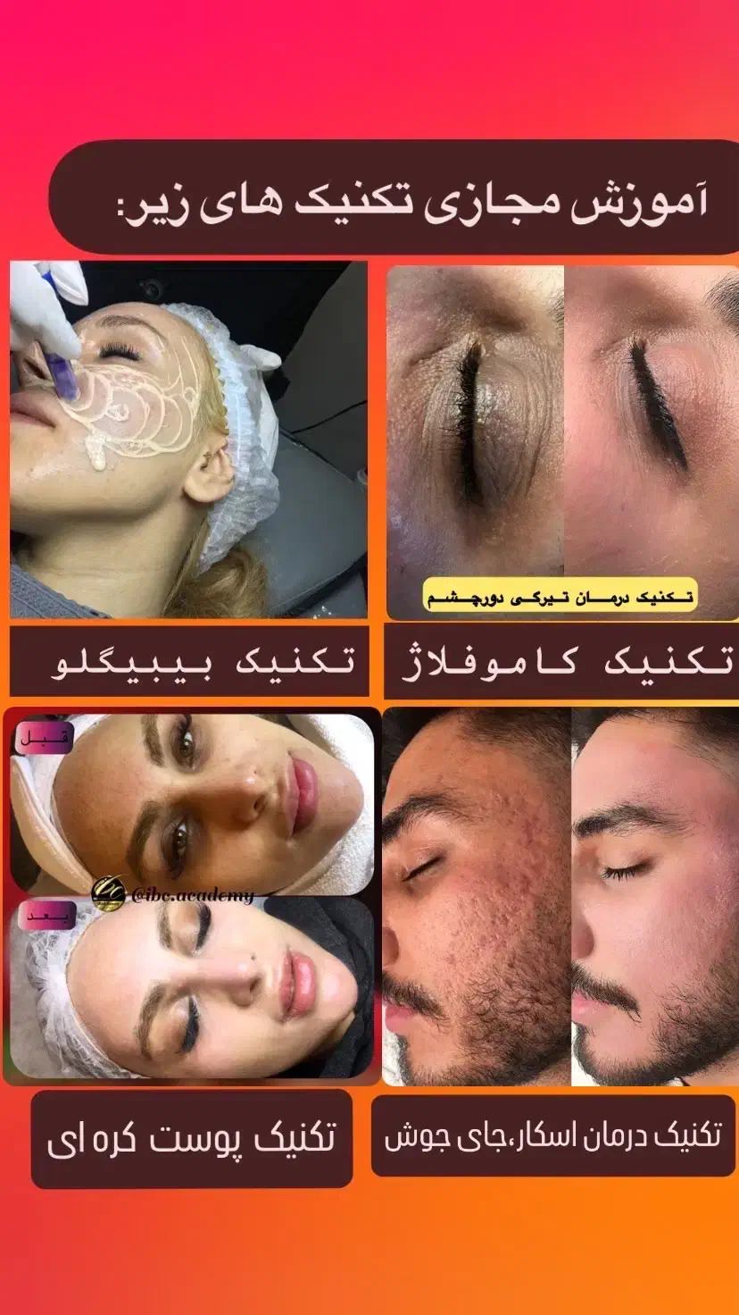 آموزش پوست شیشه ای( مجازی) محو پیسی|خدمات آموزشی|تهران, امیرآباد|دیوار