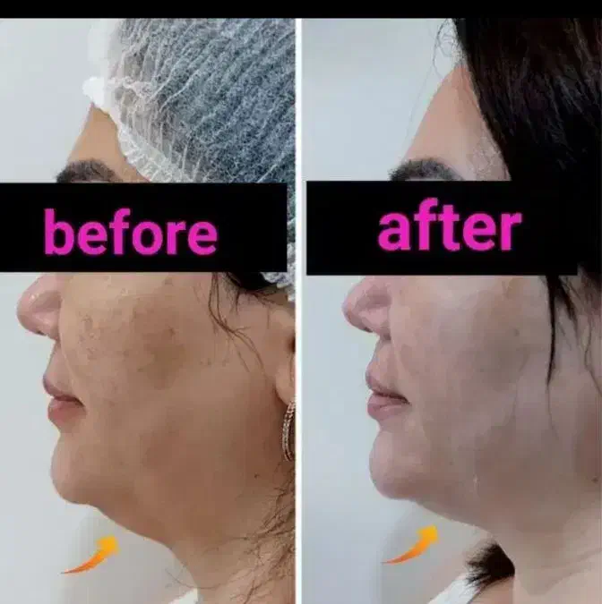 هایفوتراپی صورت ،رفع غبغب ،لاغری امبدینگ،خالبرداری|خدمات آرایشگری و زیبایی|شهر بابک, |دیوار