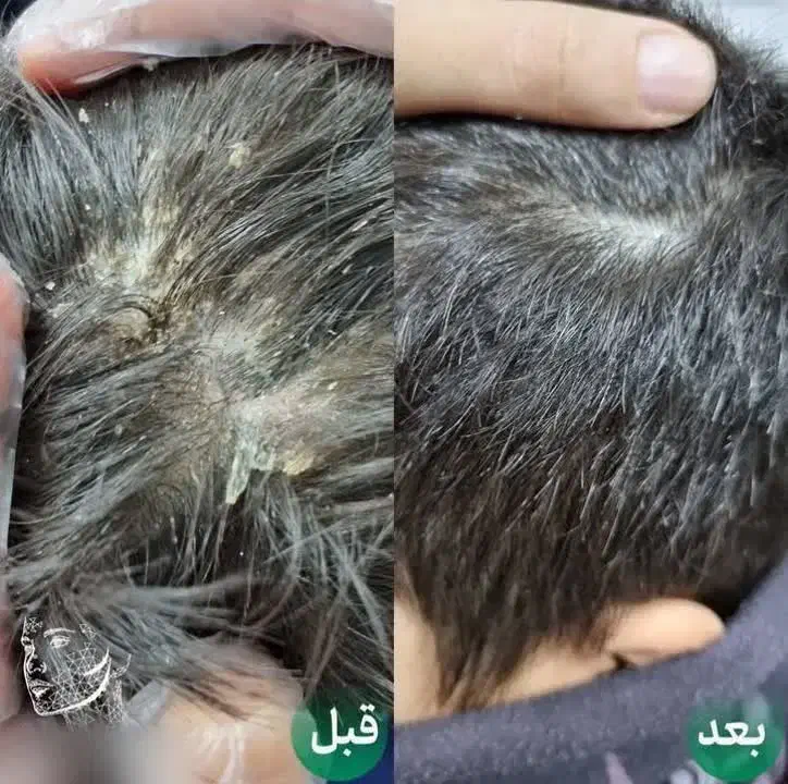 درمان رشک و شپش زیر نظر استاد حرفه ای|خدمات آرایشگری و زیبایی|قم, نیروگاه|دیوار
