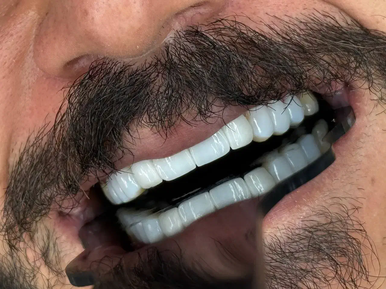 جشنواره کامپوزیت لمینیت روکش عصب ترمیم IMAX IPS|خدمات آرایشگری و زیبایی|تهران, هفت حوض|دیوار