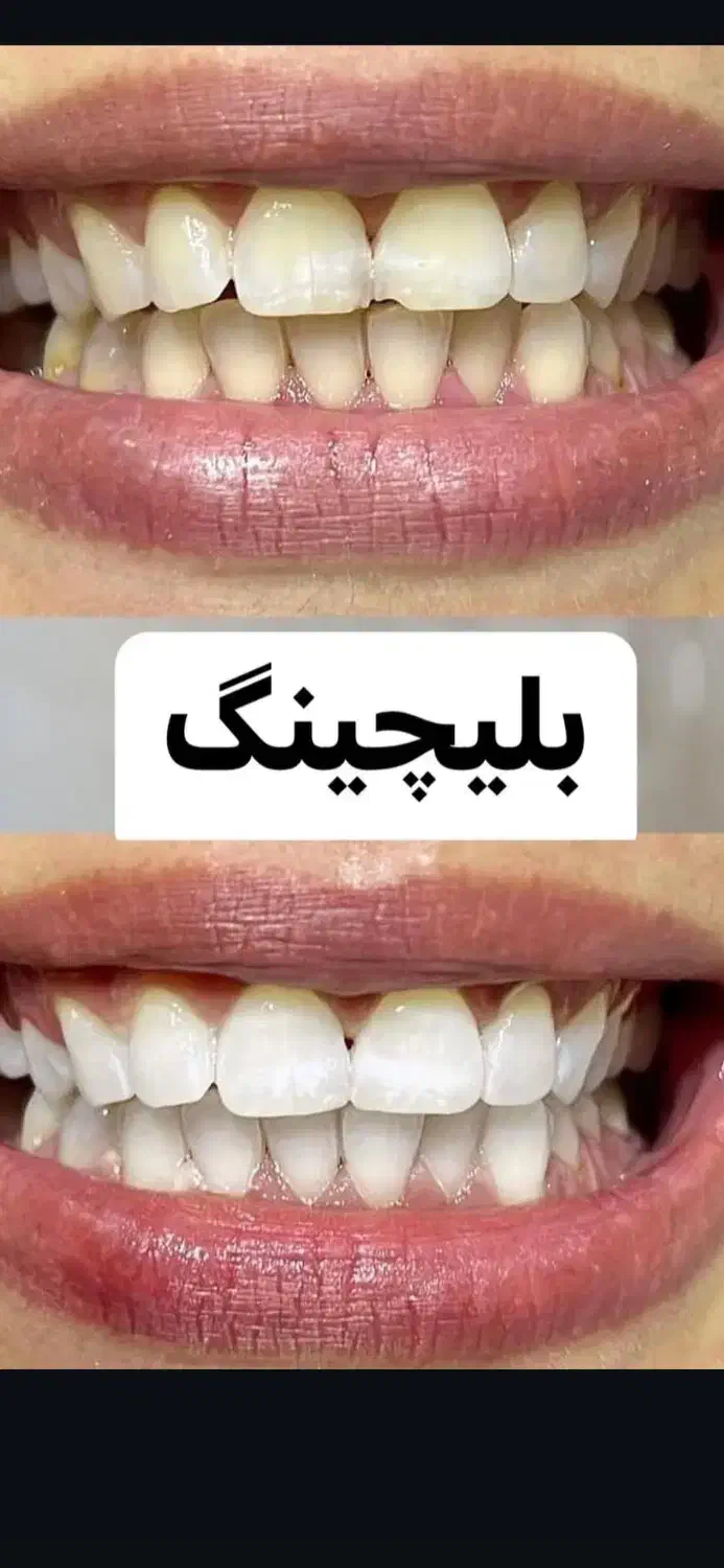 مدل خوش فیس برای بلیچینگ و سفیدکردن دندان|خدمات آرایشگری و زیبایی|تهران, دریاچه شهدای خلیج فارس|دیوار