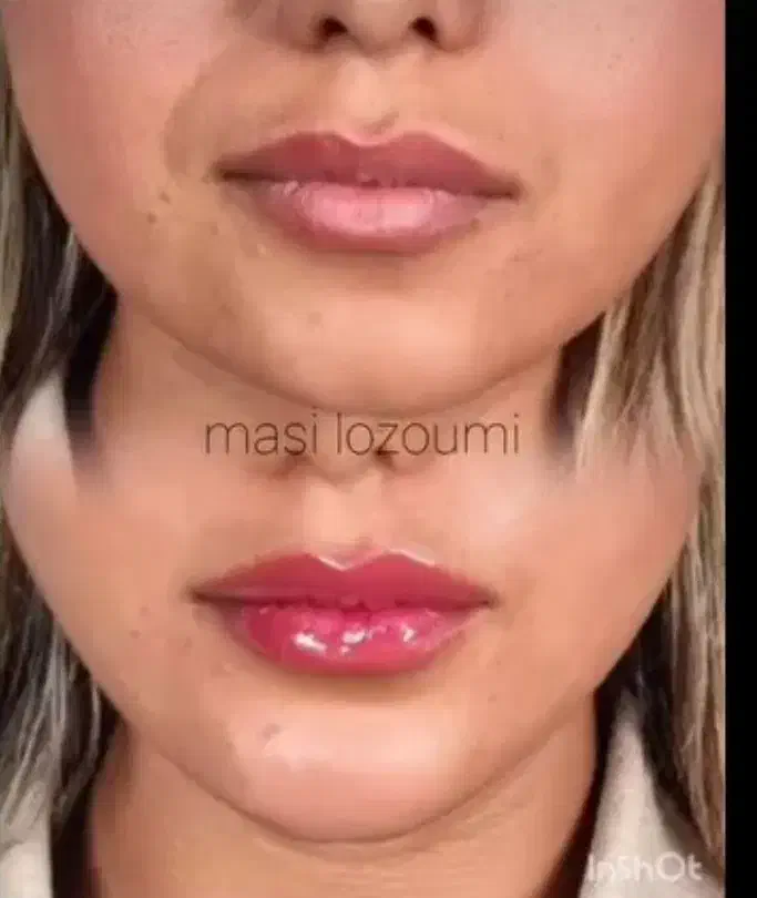 مرکز تخصصی ژل و بوتاکس در قزوین|خدمات آرایشگری و زیبایی|قزوین, |دیوار