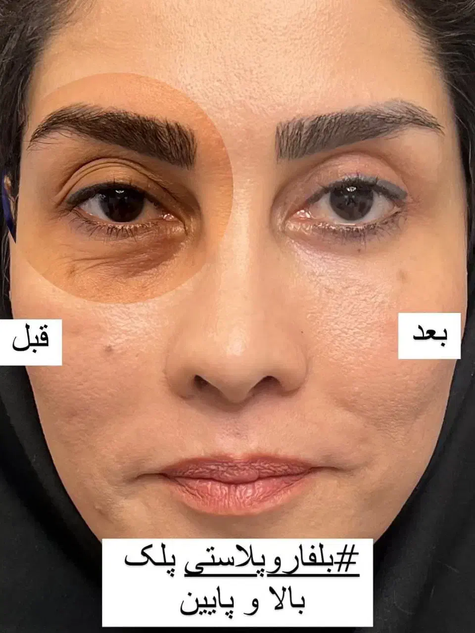 خال برداری، پاک کردن تتو، بلفاروپلاستی در تهران|خدمات آرایشگری و زیبایی|باقرشهر, |دیوار