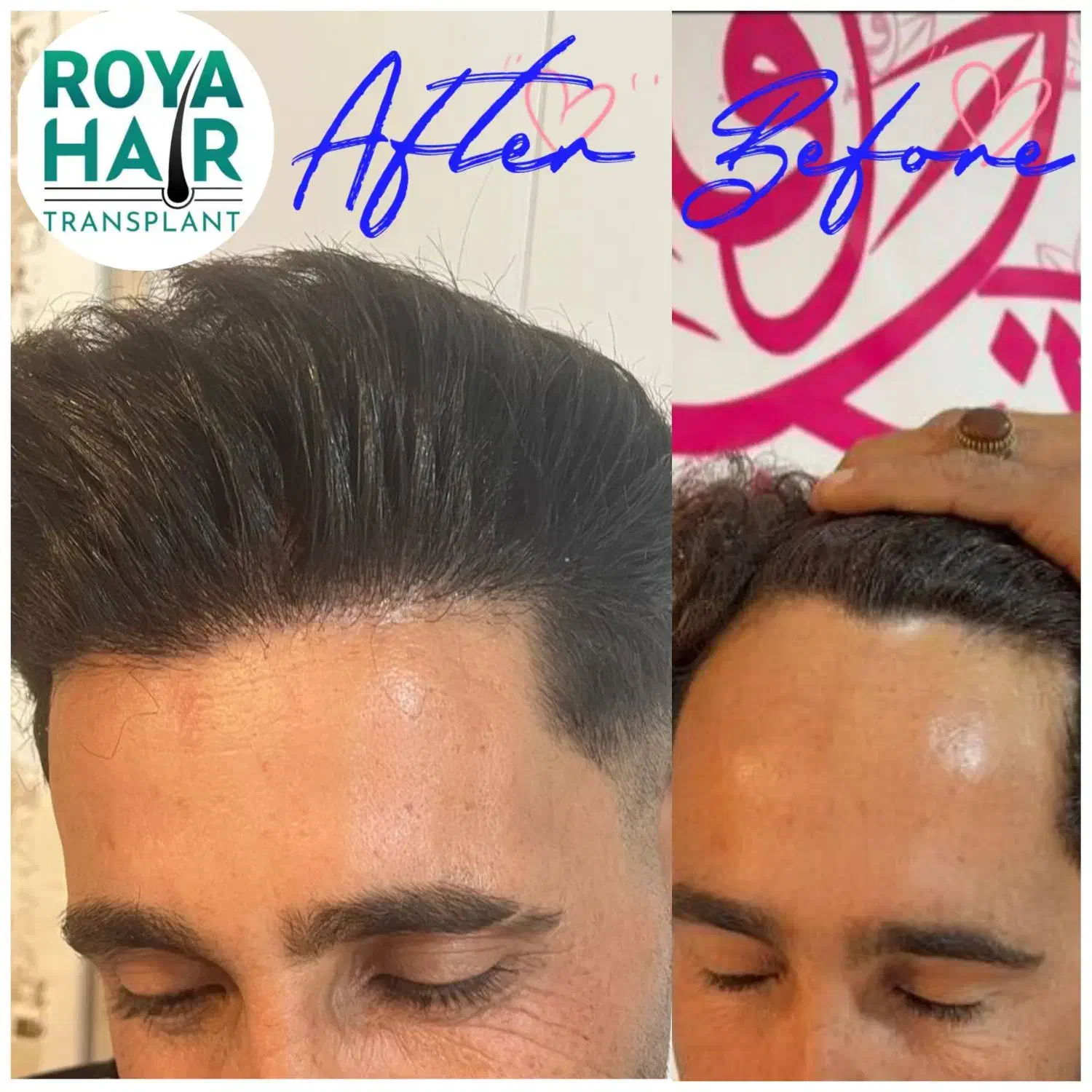 آموزش کاشت مو ابرو صفرتاصد آنلاین شهرستان یاحضوری|خدمات آموزشی|شیراز, قدوسی غربی|دیوار