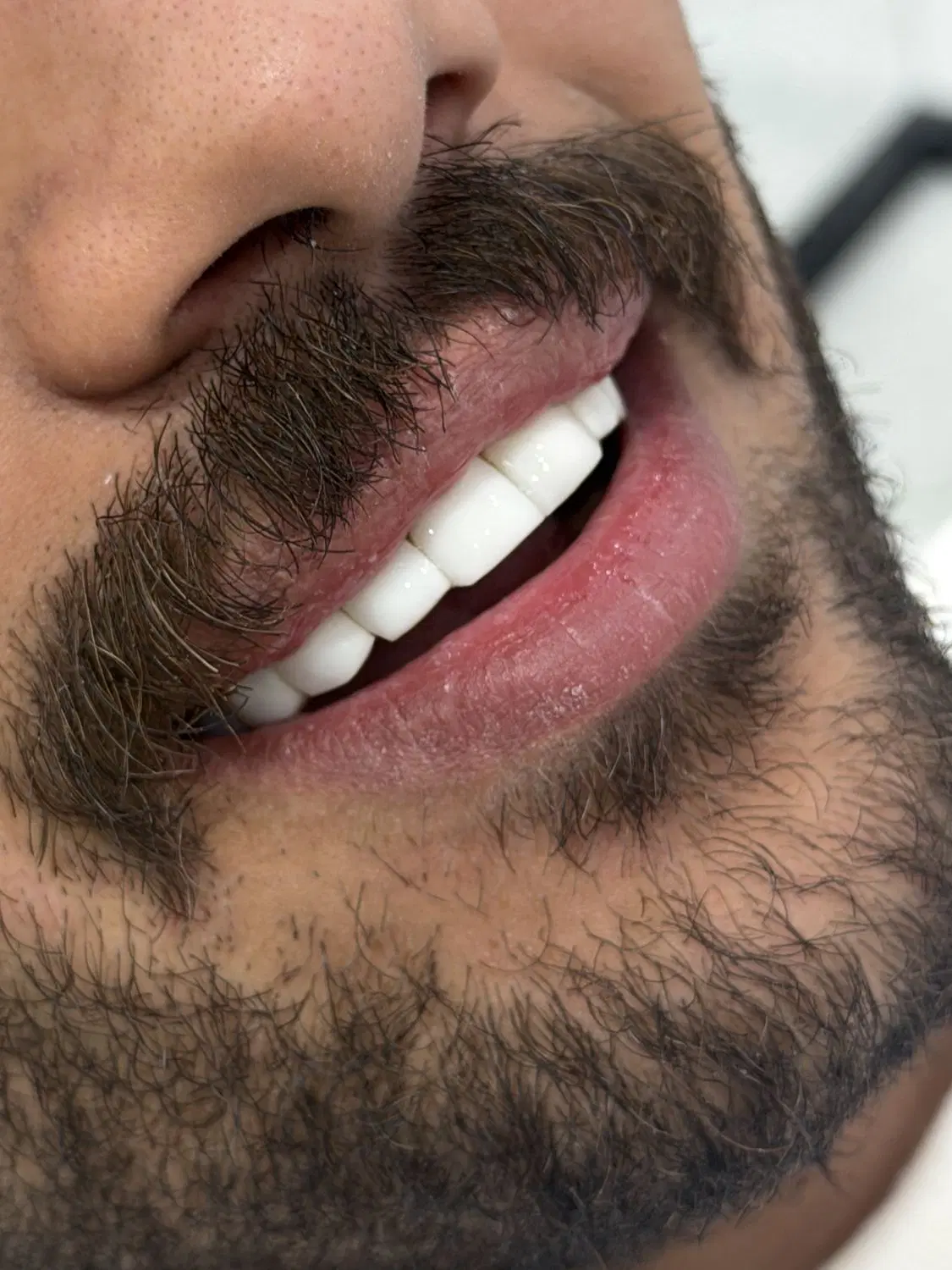 کامپوزیت/روکش/عصبکشی/ایمپلنت/لمینت|خدمات زیبایی و سلامت|تهران, فردوس|دیوار