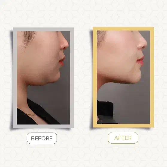 ساکشن غبغب|خدمات آرایشگری و زیبایی|رشت, گلسار|دیوار