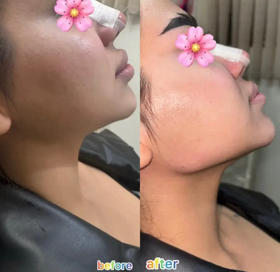 تزریق فیلر،ژل لب،فیلربینی|خدمات آرایشگری و زیبایی|شیراز, ریشمک|دیوار