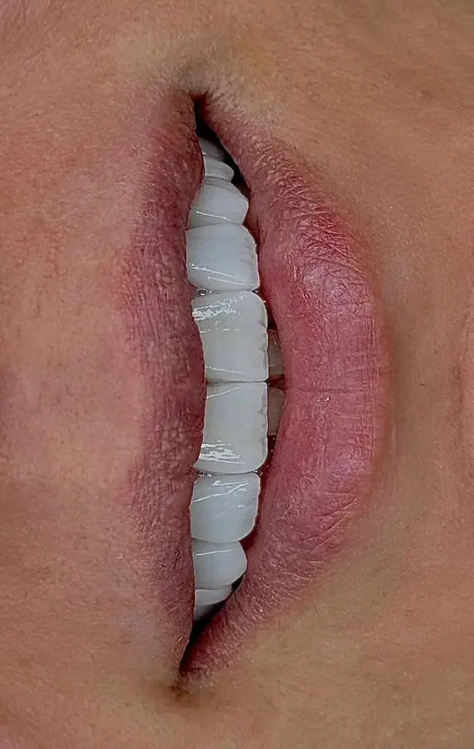 آموزش کامپوزیت دندان|خدمات آموزشی|اسلامشهر, شهرک مفیدی|دیوار