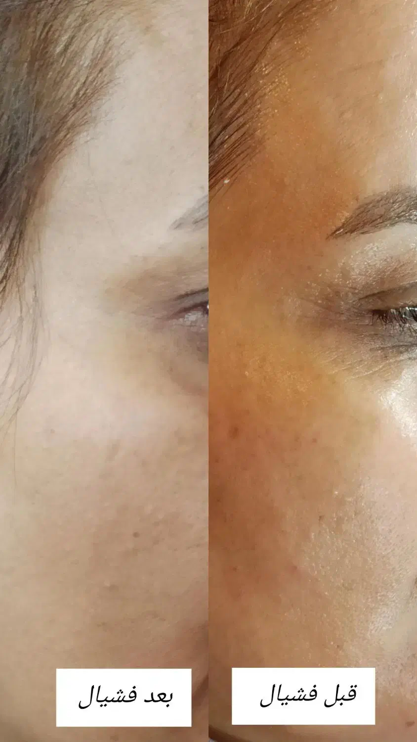 جشنواره پاکسازی پوست فقط سیصد تومان کپشن رو بخون|خدمات آرایشگری و زیبایی|مشکین‌دشت, |دیوار