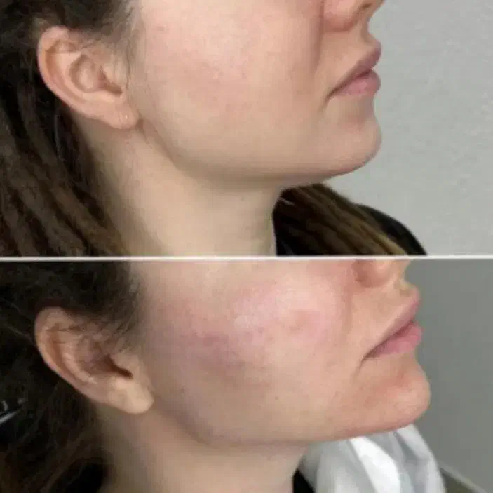 تزریق ژل وبوتاکس(سی سی ۵۰۰)ارایش دائم صورت،پیرسینگ|خدمات آرایشگری و زیبایی|آزادشهر, |دیوار