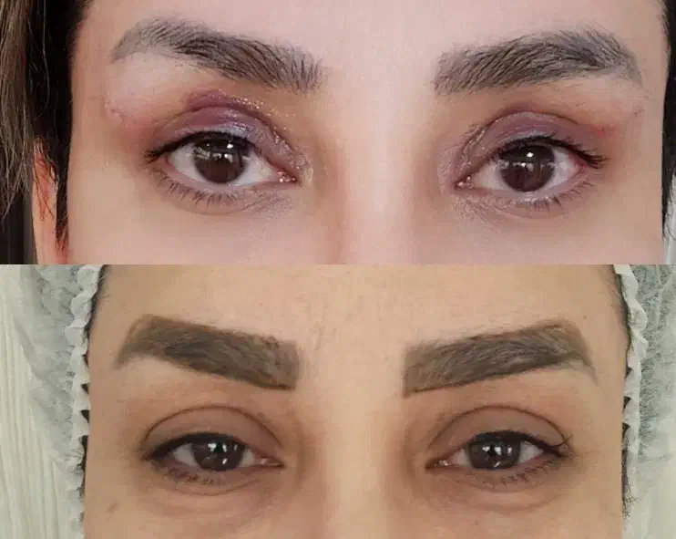 بلفاروپلاستی ساکشن غبغب|خدمات آرایشگری و زیبایی|اصفهان, مهدی آباد|دیوار