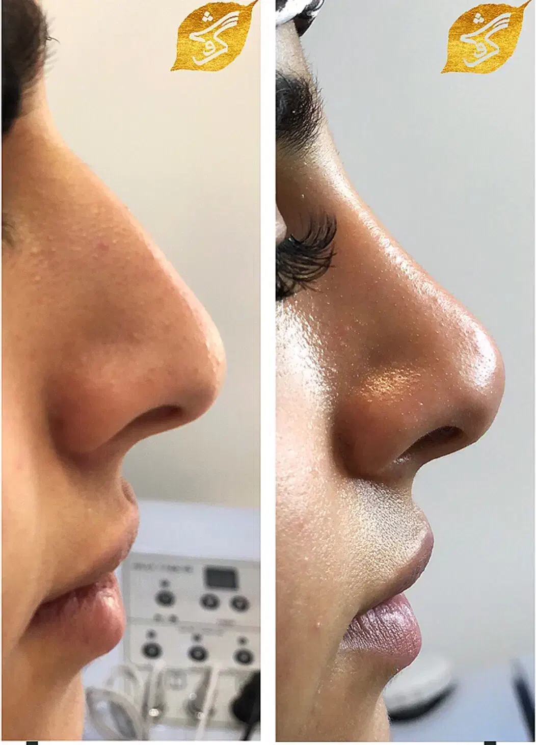 تزریق آنزیم و فیلر بینی|خدمات آرایشگری و زیبایی|تهران, پاسداران|دیوار