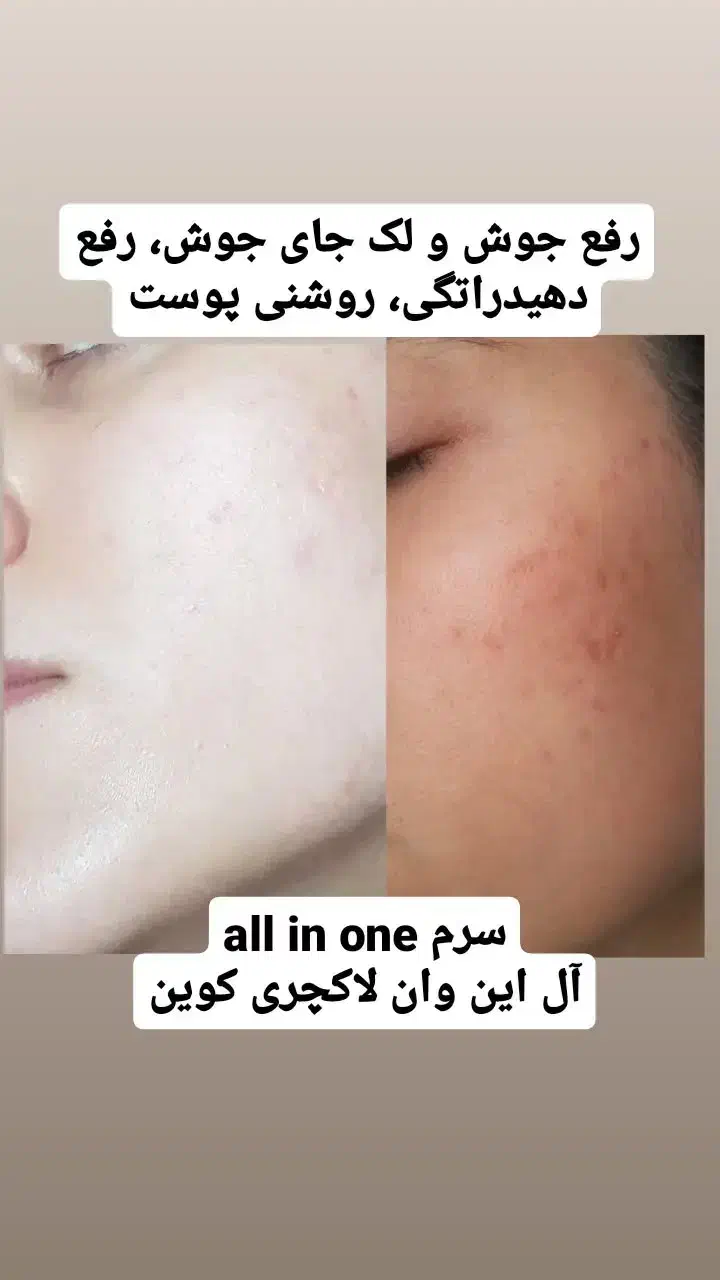پکیج درمان لک ویژه|آرایشی، بهداشتی، درمانی|تهران, فردوسی|دیوار