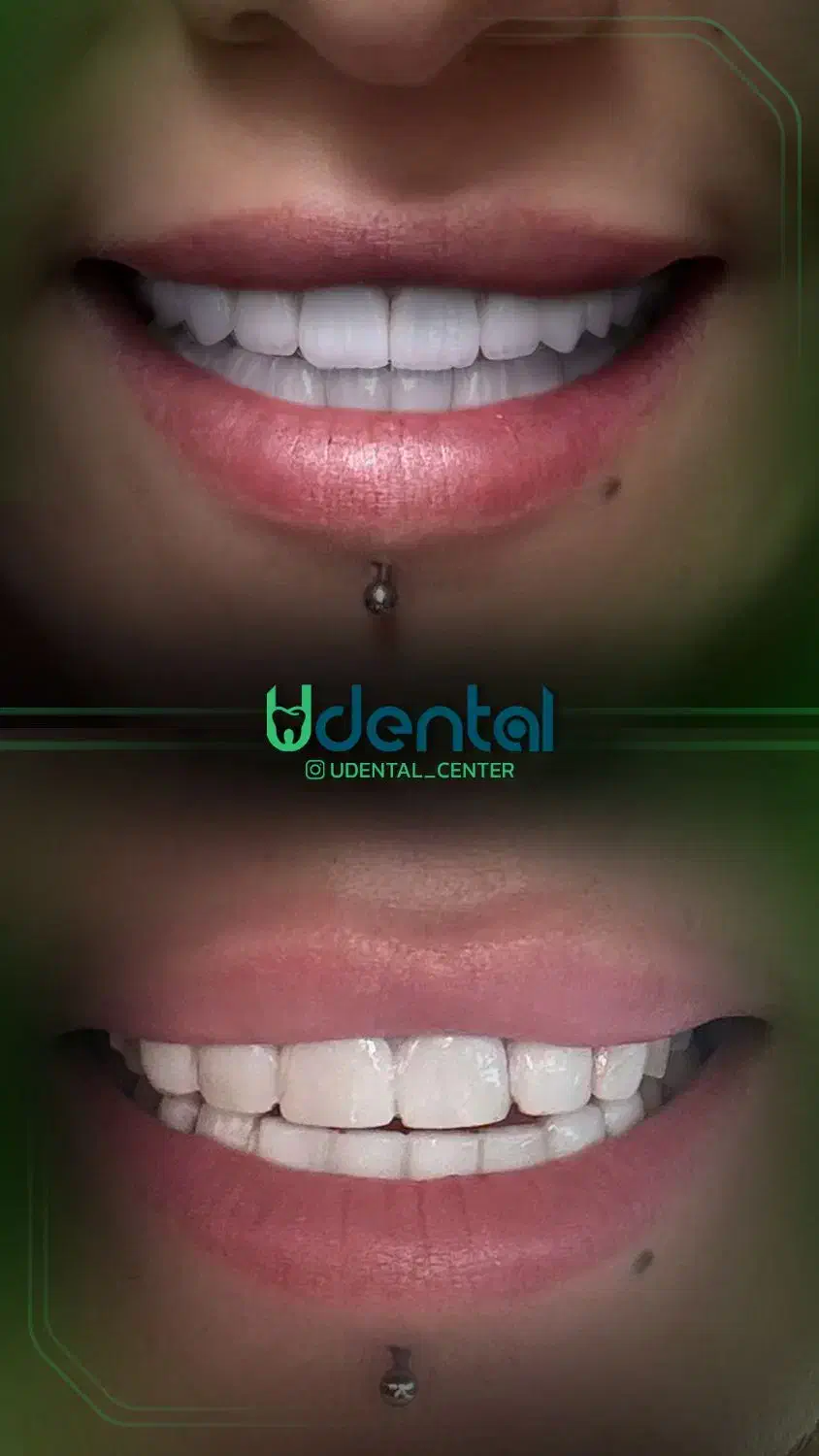 کامپوزیت، لمینت، ایمپلنت اقساط ویژه|خدمات آرایشگری و زیبایی|تاکستان, |دیوار