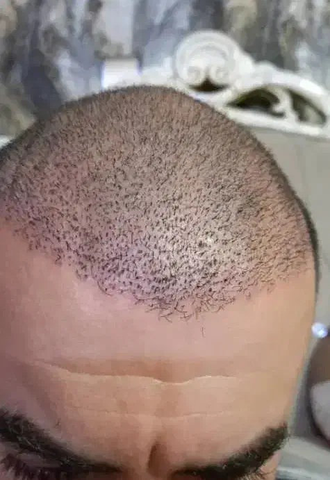 آفر ویژه کاشت مو و ابرو|خدمات آرایشگری و زیبایی|تهران, دبستان|دیوار