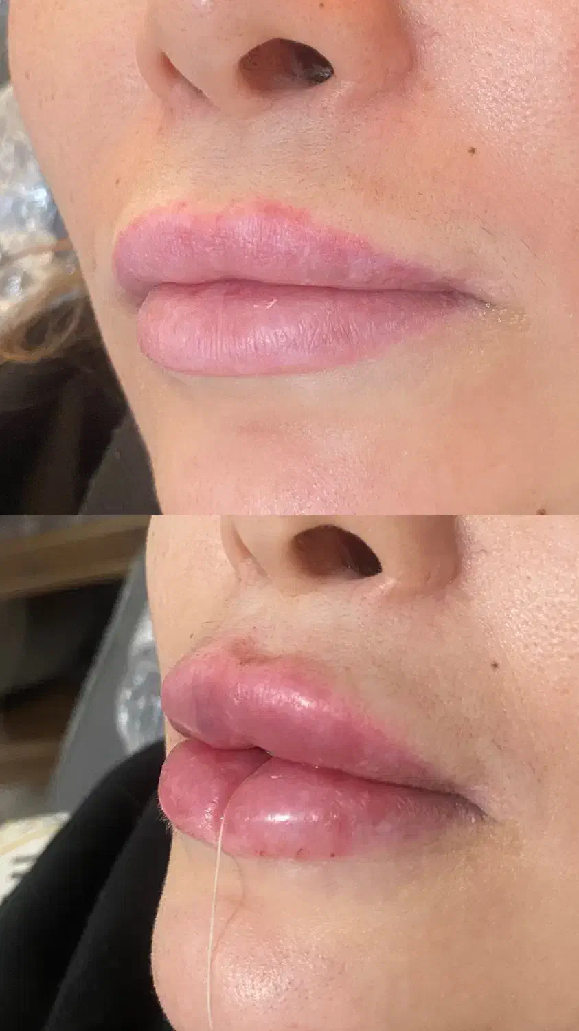 تخفیف۵۰٪ بوتاکس و فیلر (فقط یک هفته)|خدمات آرایشگری و زیبایی|ری, شهرری|دیوار