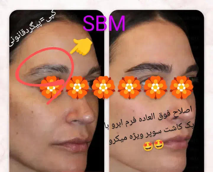 کاشت فوق حرفه/جدیدترین متدسوپرمیکروit+ مو/ابرو/ریش|خدمات آرایشگری و زیبایی|مشهد, هفت تیر (آب و برق)|دیوار