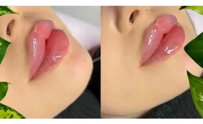 مدل ژل لب گونه چونه زاویه خط خنده ۴۰۰ ت|خدمات آرایشگری و زیبایی|قم, تولید دارو و یخچال|دیوار