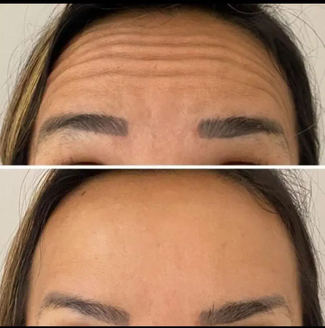 ژل و بوتاکس تخفیف 50 درصدی با چک صیادی|خدمات آرایشگری و زیبایی|مشهد, فلسطین|دیوار