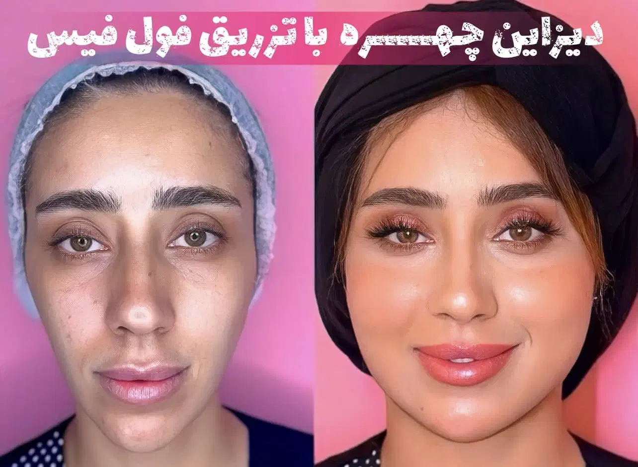 بوتاکس خطوط پیشانی و اخم رایگان‌ شد|خدمات آرایشگری و زیبایی|قم, هفت تیر|دیوار